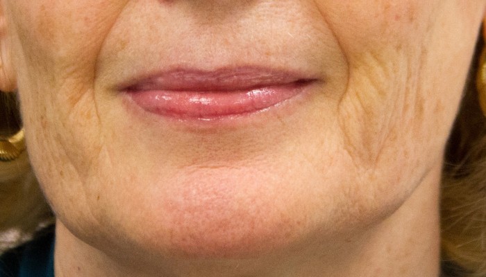 Chin before treatment