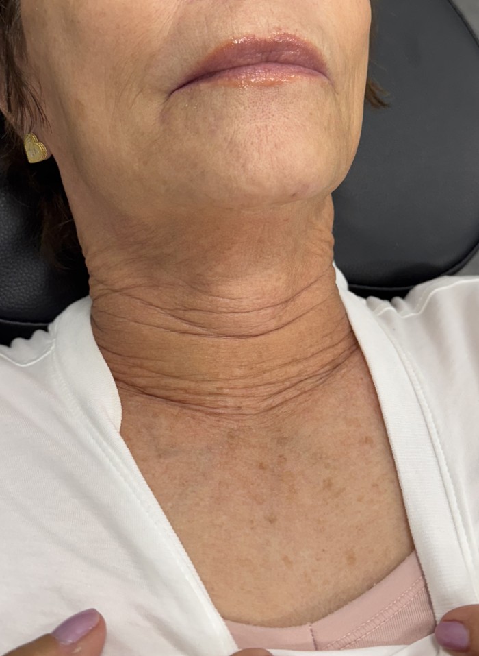 Neck before