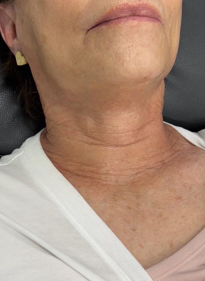Neck after