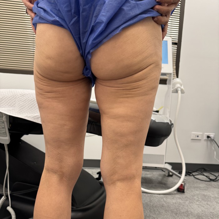 Cellulite before