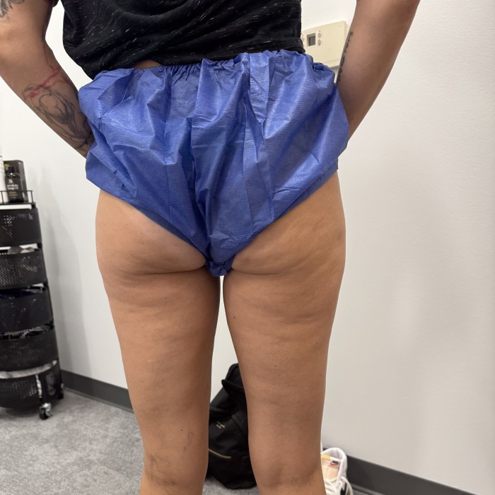Legs Cellulite After