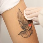 Laser tattoo removal